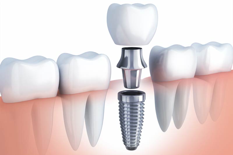 Implants Dentist in Northridge